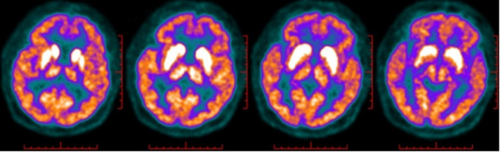Autoimmune encephalitis associated with anti-LGI1 antibody: a potential cause of neuropsychiatric systemic lupus erythematosus.