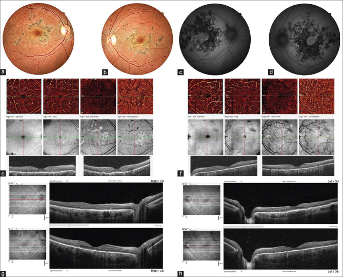 An acute posterior multifocal placoid pigment epitheliopathy with presumed systemic lupus erythematosus etiology.