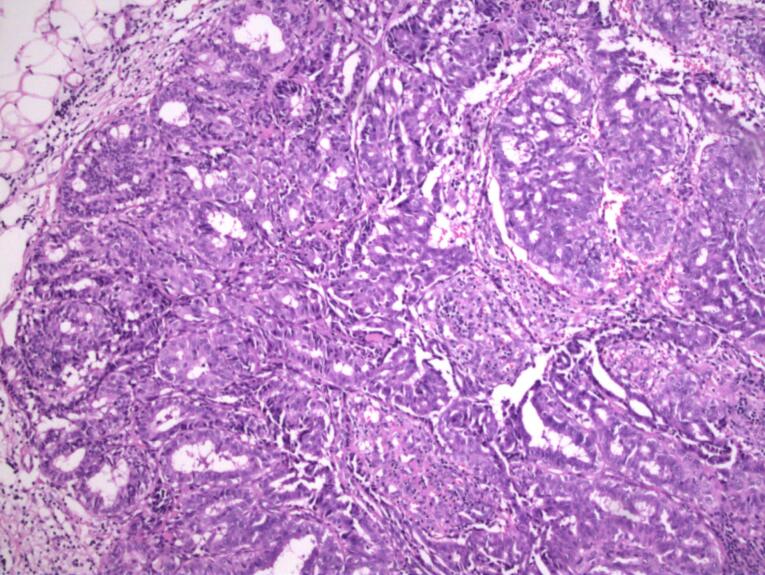 Lactating Adenoma in Pregnancy: Report of Three Cases.