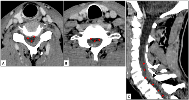 Spontaneous Spinal Epidural Hematoma Under Rivaroxaban and Clopidogrel: A Case Report and Literature Review.
