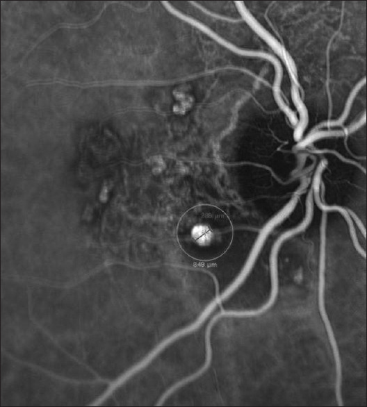 Spontaneous resolution of photodynamic therapy-induced acute exudative maculopathy in a patient suffering from polypoidal choroidal vasculopathy: A case report with 3-year follow-up.