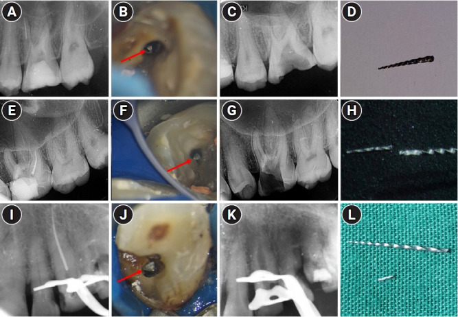 Pattern of endodontic instrument separation and factors affecting its retrieval: a 10-year retrospective observational study in a postgraduate institute.