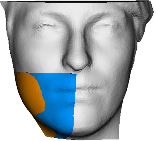 Evaluation of the usefulness of platelet-rich fibrin (PRF) in mandibular third molar surgery with 3D facial swelling analysis: a split-mouth randomized clinical trial.