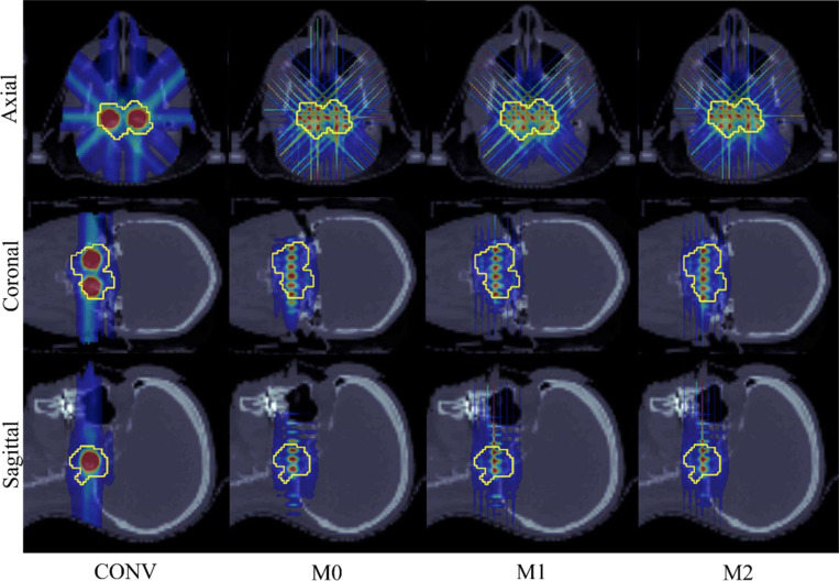 Minibeam-pLATTICE: A novel proton LATTICE modality using minibeams.