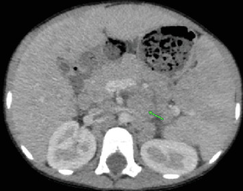Pediatric T-Cell/Histiocyte-Rich Large B-Cell Lymphoma (THRLBC) in an 8-Year-Old Male Child: A Case Report.