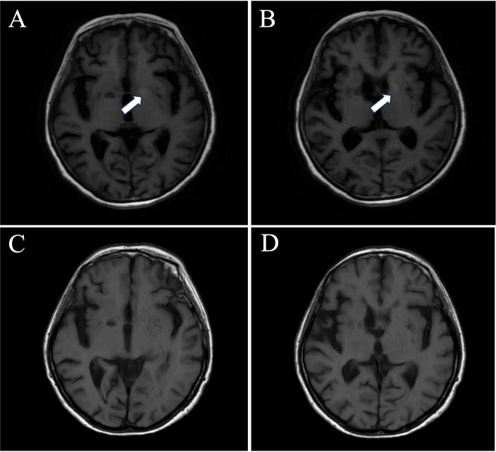 Autoimmune encephalitis associated with anti-LGI1 antibody: a potential cause of neuropsychiatric systemic lupus erythematosus.