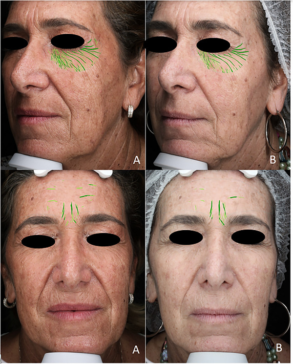 Non-Invasive Imaging for the Evaluation of a New Oral Supplement in Skin Aging: A Case-Controlled Study.