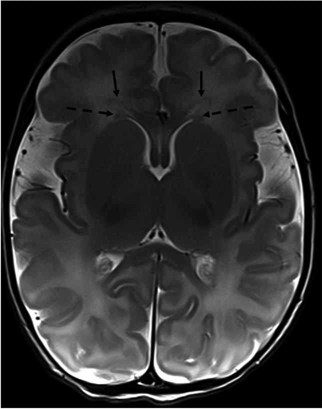 Neonatal Brain MRI: Periventricular Germinal Matrix Mimicking Hypoxic-ischemic White Matter Injuries.