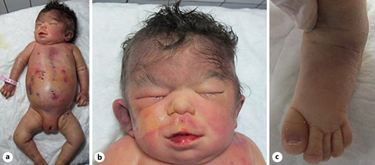 A Novel Truncating Variant in Sandestig-Stefanova Syndrome with Hydrocephalus.