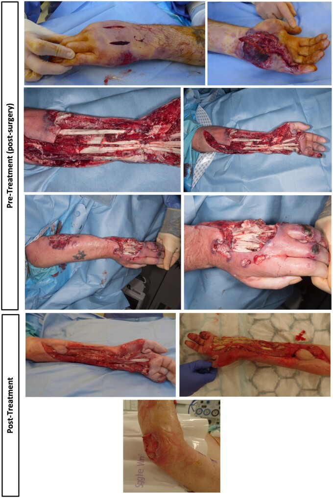 Jeopardy to life and limb-using immunogenotyping to characterize inflammatory phenotypes: a case report.
