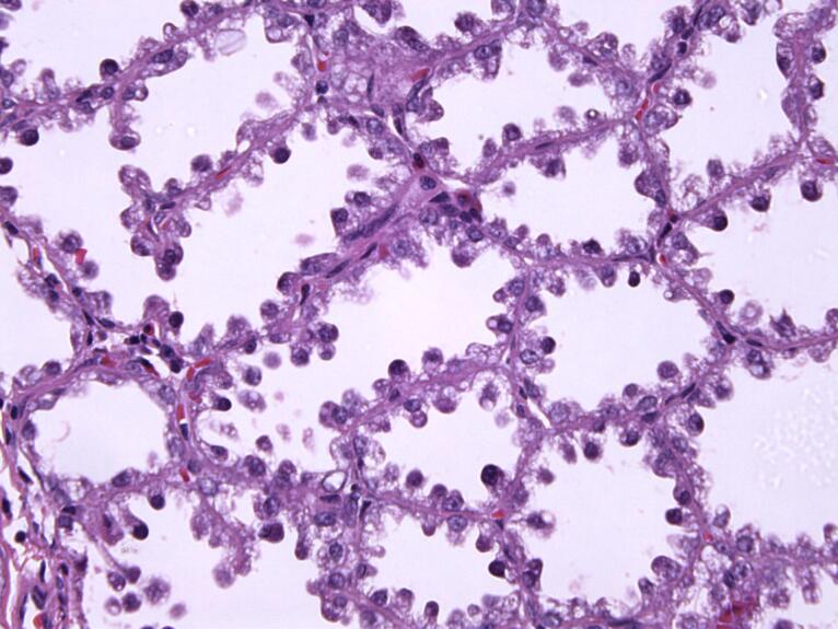 Lactating Adenoma in Pregnancy: Report of Three Cases.