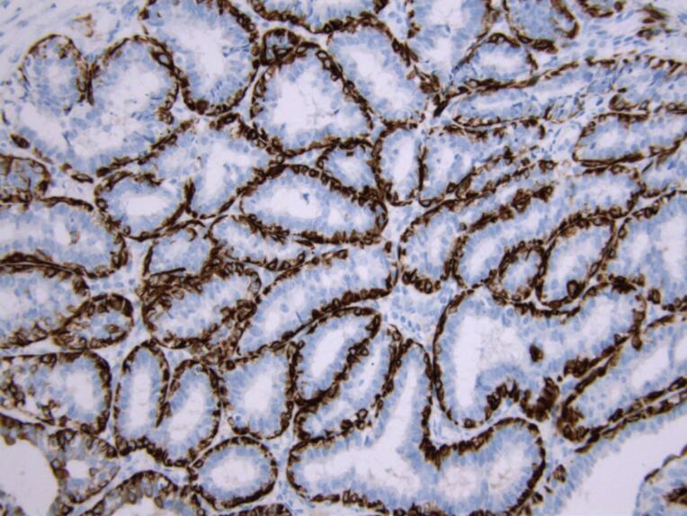 Lactating Adenoma in Pregnancy: Report of Three Cases.