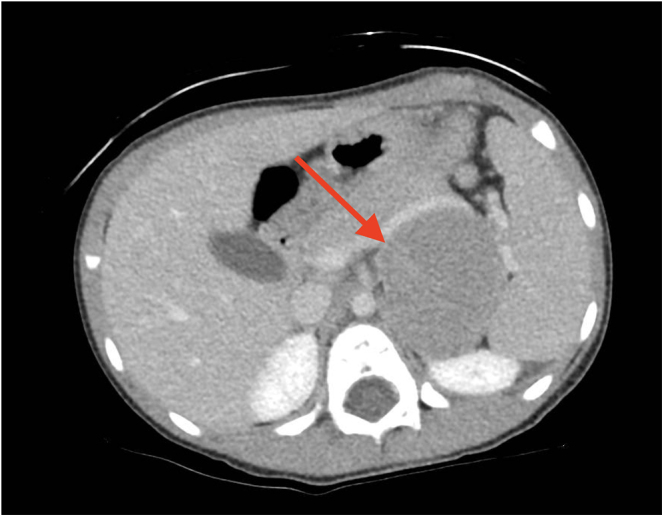 Androgen producing oncocytic adrenocortical tumor in a 3.7-year-old female.