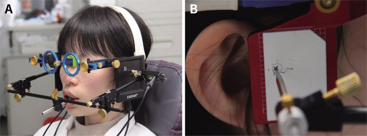 Comparison of the accuracy of an ultrasonic-based jaw tracking device with conventional electronic tracking device.