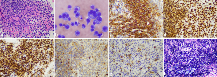 An Unusual Case of Extracavitary/Solid Variant Primary Effusion Lymphoma With Associated Hemophagocytic Lymphohistiocytosis.