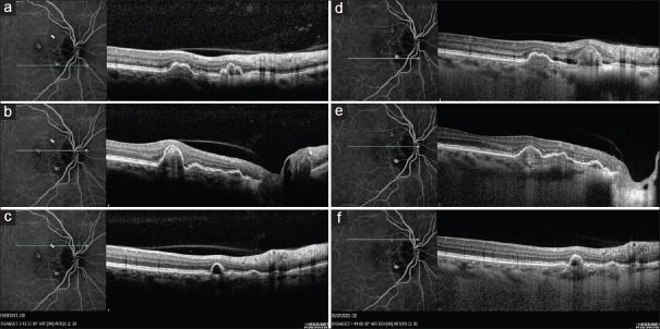 Spontaneous resolution of photodynamic therapy-induced acute exudative maculopathy in a patient suffering from polypoidal choroidal vasculopathy: A case report with 3-year follow-up.