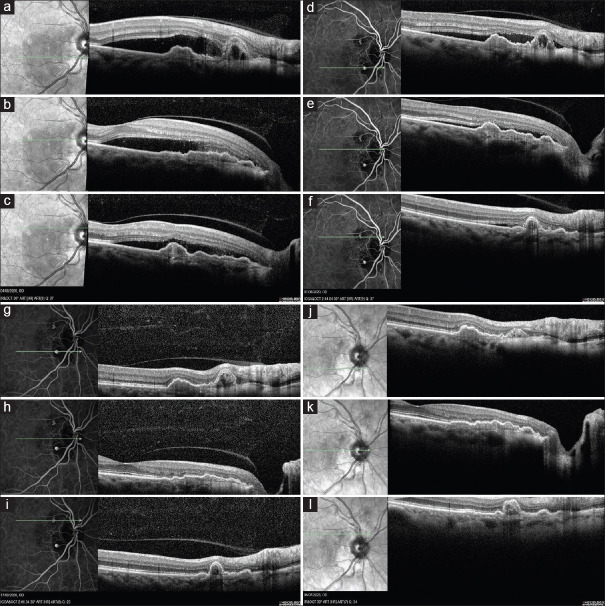 Spontaneous resolution of photodynamic therapy-induced acute exudative maculopathy in a patient suffering from polypoidal choroidal vasculopathy: A case report with 3-year follow-up.