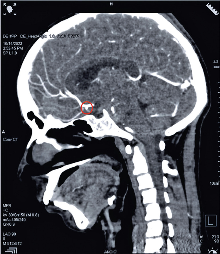Severe dengue, aneurysmal sub-arachnoid hemorrhage, and hemophagocytic lymphohistiocytosis: a rare case combination.