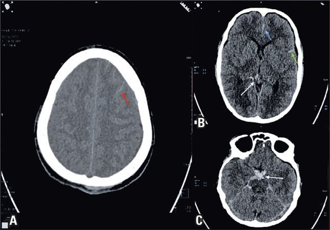 Severe dengue, aneurysmal sub-arachnoid hemorrhage, and hemophagocytic lymphohistiocytosis: a rare case combination.