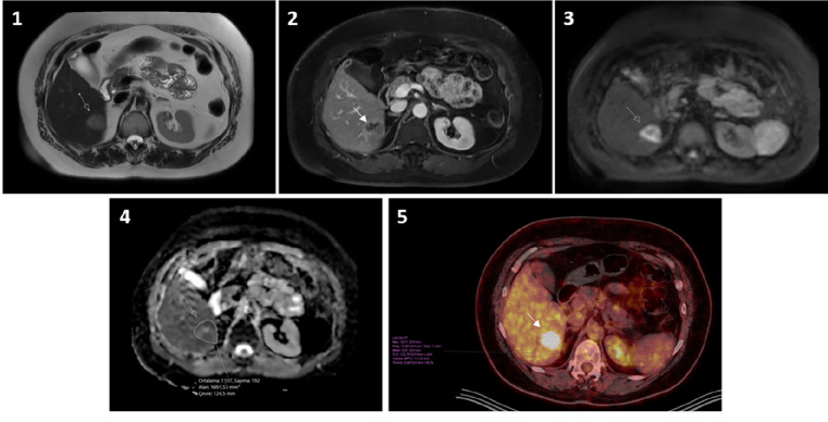 Correlation of 3T Diffusion-weighted MRI and <sup>18</sup>F-FDG-PET/CT in Liver Metastases: SUV Versus ADC.
