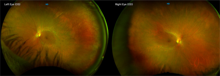 Progressive Retinal Degeneration and Juvenile Nephronophthisis in a Patient with Autosomal Recessive Ciliopathy: A Case Report.