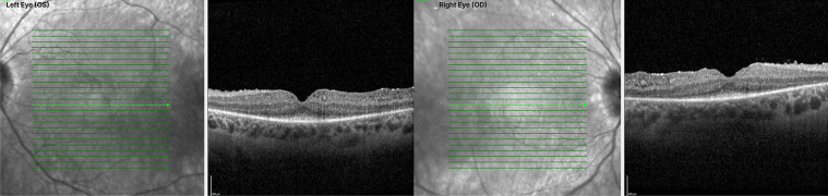 Progressive Retinal Degeneration and Juvenile Nephronophthisis in a Patient with Autosomal Recessive Ciliopathy: A Case Report.