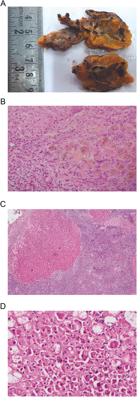 A novel approach to intraoperative diagnosis of primary pigmented nodular adrenocortical disease.
