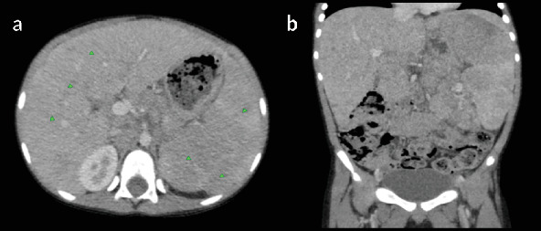 Pediatric T-Cell/Histiocyte-Rich Large B-Cell Lymphoma (THRLBC) in an 8-Year-Old Male Child: A Case Report.