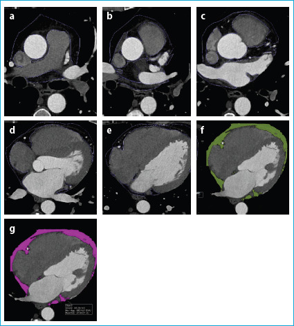 Prognostic Value of Epicardial Fat Volume Quantification Related to Coronary Artery Calcium Score and Degree of Stenosis on Coronary CT Angiography.