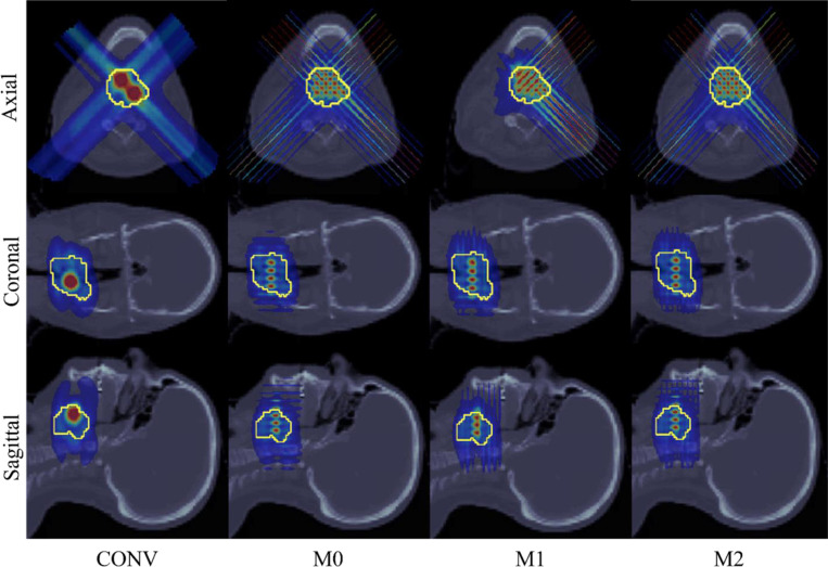 Minibeam-pLATTICE: A novel proton LATTICE modality using minibeams.