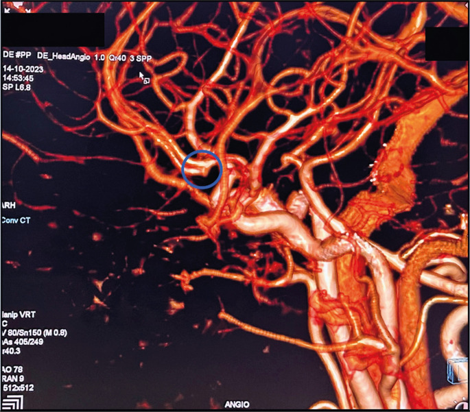 Severe dengue, aneurysmal sub-arachnoid hemorrhage, and hemophagocytic lymphohistiocytosis: a rare case combination.