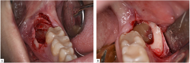 Evaluation of the usefulness of platelet-rich fibrin (PRF) in mandibular third molar surgery with 3D facial swelling analysis: a split-mouth randomized clinical trial.