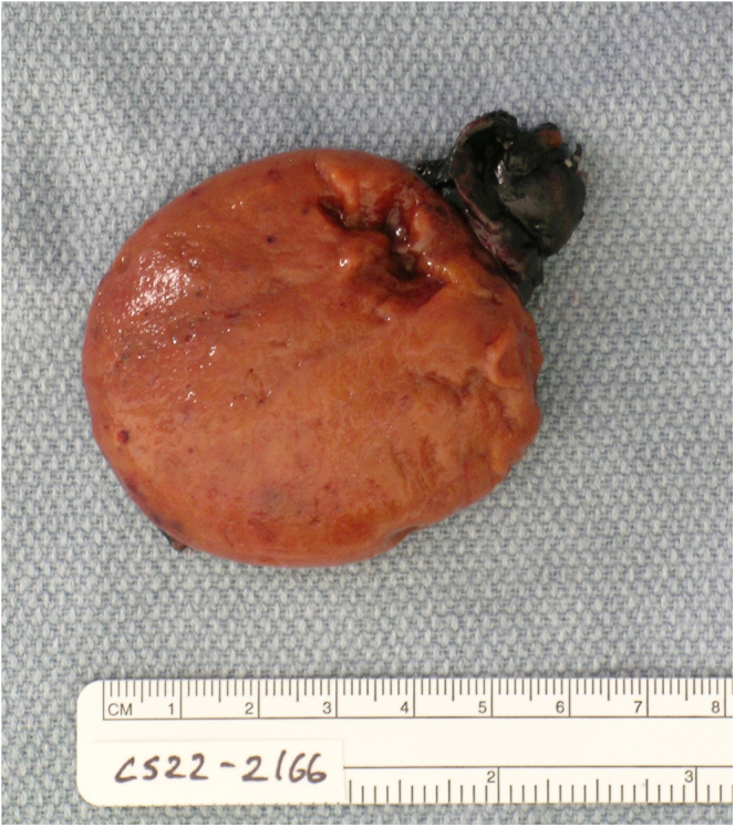 Androgen producing oncocytic adrenocortical tumor in a 3.7-year-old female.