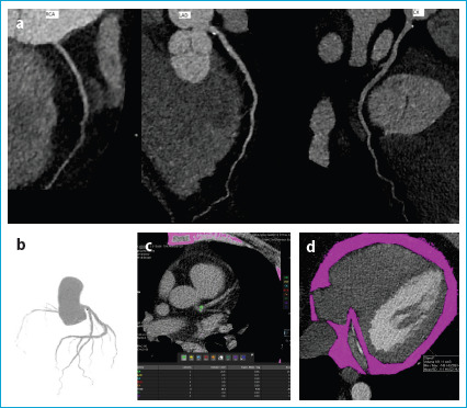 Prognostic Value of Epicardial Fat Volume Quantification Related to Coronary Artery Calcium Score and Degree of Stenosis on Coronary CT Angiography.
