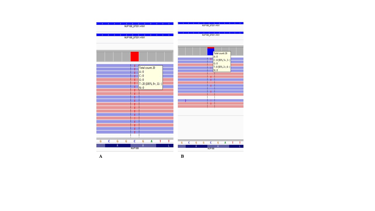 A Novel Truncating Variant in Sandestig-Stefanova Syndrome with Hydrocephalus.