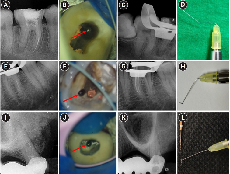 Pattern of endodontic instrument separation and factors affecting its retrieval: a 10-year retrospective observational study in a postgraduate institute.