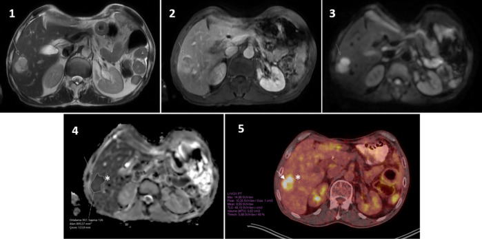 Correlation of 3T Diffusion-weighted MRI and <sup>18</sup>F-FDG-PET/CT in Liver Metastases: SUV Versus ADC.