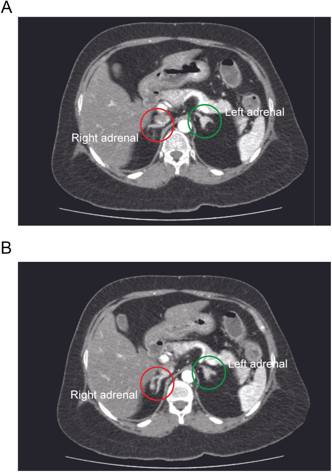 A novel approach to intraoperative diagnosis of primary pigmented nodular adrenocortical disease.