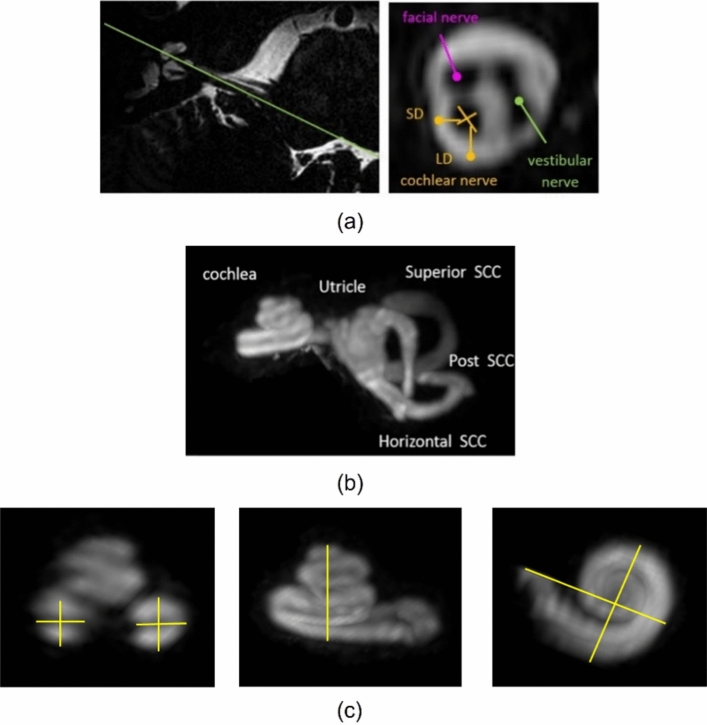 Morphology of the human inner ear and vestibulocochlear nerve assessed using 7 T MRI.