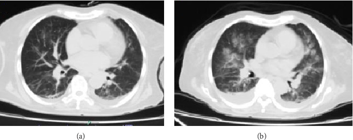 Overlap Syndrome in Late-Onset Systemic Lupus Erythematosus With Lupus Nephritis and MPO-ANCA Pauci-Immune Glomerulonephritis and Tuberculosis: An Uncommon Association.