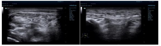Clinicopathological diagnosis of morphea-like carcinoma en cuirasse in the neck: a rare presentation of lung cancer.