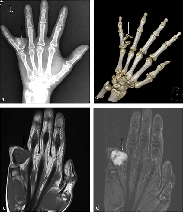Periosteal Chondroma of the Fifth Finger.