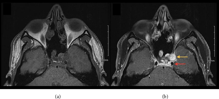 The Bezold-Jarisch Reflex Following an Endoscopic Endonasal Resection of an Intraosseous Clival Myxoma: A Case Report.