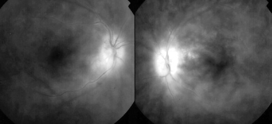 Specific retinal vasculitis in HLA-A29 birdshot retinochoroiditis, distinguishing it from other causes of vasculitis: A pilot study.