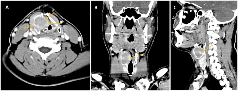 Giant cell tumour of the larynx-a diagnostic challenge.