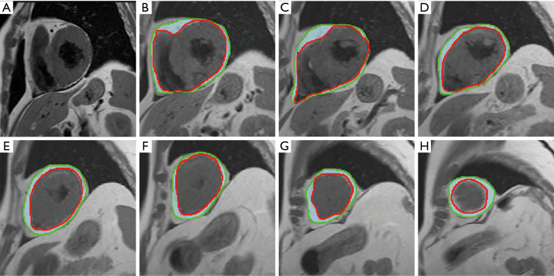 Epicardial fat volume assessment and strain analysis by cardiac magnetic resonance: a novel method for evaluating microcirculation dysfunction after myocardial infarction.