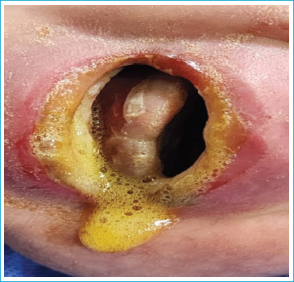 A Newborn Case of Esophagus and Vocal Cord Burn After CS (O-Chlorobenzylindene Malononitrile) Gas Inhalation.