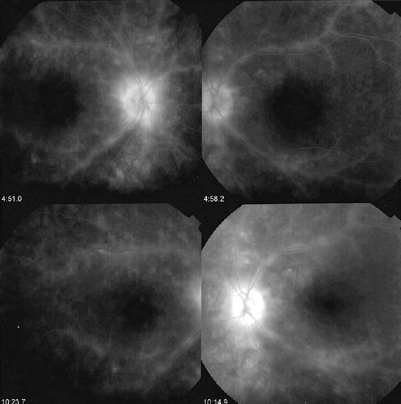 Specific retinal vasculitis in HLA-A29 birdshot retinochoroiditis, distinguishing it from other causes of vasculitis: A pilot study.