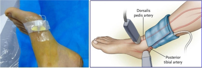 Effect of different balloon pressure band compression regimens on thrombolysis and lower limb venous blood flow velocity in patients undergoing anterograde thrombolysis via the superficial dorsalis pedis vein.