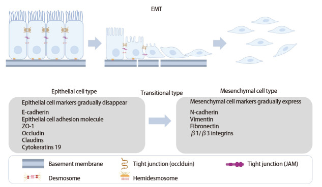 [Epithelial-mesenchymal Transition: Biological Basis and Clinical Prospects  of Lung Cancer Invasion, Metastasis, and Drug Resistance].